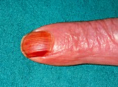 Nicotine stain on fingernail of a cigarette smoker