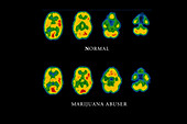 Cannabis brain scans