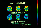Coloured PET scans of an ex-cocaine user's brain
