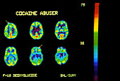 PET scans of brain of a cocaine user