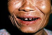 Close-up of Betel-stained teeth of Thai woman