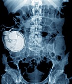 Intrathecal drug delivery,X-ray