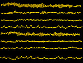 Normal EEG read out of the brains alpha waves