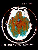 Early CAT scan of the brain (axial section)