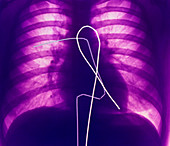 Colour X-ray depicting heart catheterization