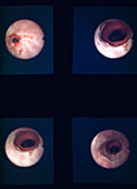 Endoscopic view of lower oesophagus