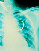X-ray of left lung showing bronchoscope