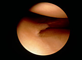 Athroscopic image of damaged knee cartilage