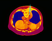 Coloured CT scan showing a lung biopsy