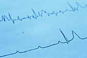 Third-degree heart block