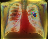 Coloured X-ray of chest showing heart pac