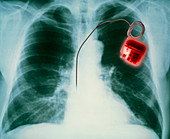 Heart pacemaker X-ray