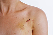 Scar from pacemaker operation