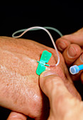Inserting butterfly cannula into vein