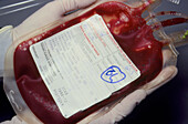 Blood bag containing umbilical cord blood