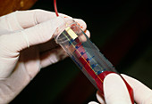 Blood sample dripping into vial by gravity method