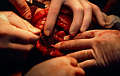 Open uterus fetal surgery; hand & head exposed
