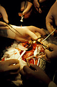 Open uterus fetal surgery: installing prostheses