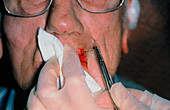Stitching of elderly man's lacerated lip
