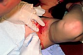 Axillary abscess being surgically cut for drainage