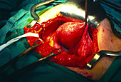 Woman's uterus being removed surgically