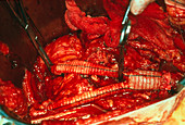 Surgery to replace an aneurysm of the aorta