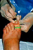 Toenail surgery