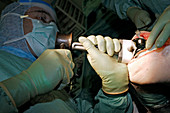 Knee replacement surgery