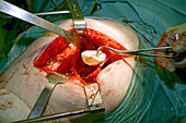 Hip replacement surgery