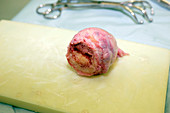 Surgery to remove a tumour in the pelvis