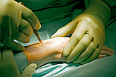 Carpal tunnel syndrome surgery