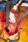 Hip replacement surgery