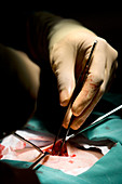 Varicose vein surgery