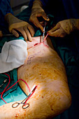 Varicose vein surgery