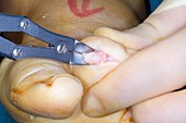 Bunion surgery