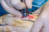 Bunion surgery