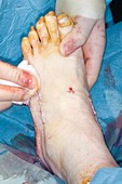 Ankle surgery