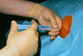 Patient undergoing an epidural anaesthesia