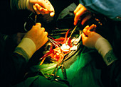 Surgery to replace heart valve