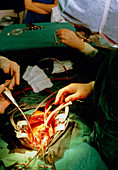 Surgery in progress to replace mitral heart valve