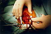 Paediatric heart transplant: close-up of heart