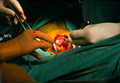 Paediatric heart transplant: close-up of heart