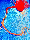 Angiogram of coronary artery before angioplasty