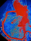 Angiogram of coronary artery after angioplasty