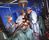 Heart bypass surgery