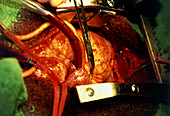 Heart surgery
