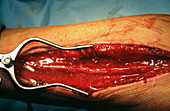 Dissecting arm artery for heart surgery
