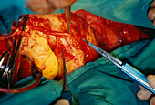 Coronary artery bypass surgery