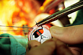 Heart valve replacement