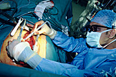 Heart bypass surgery